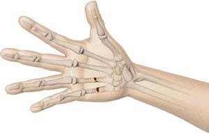 Fractures of the Hand & Fingers